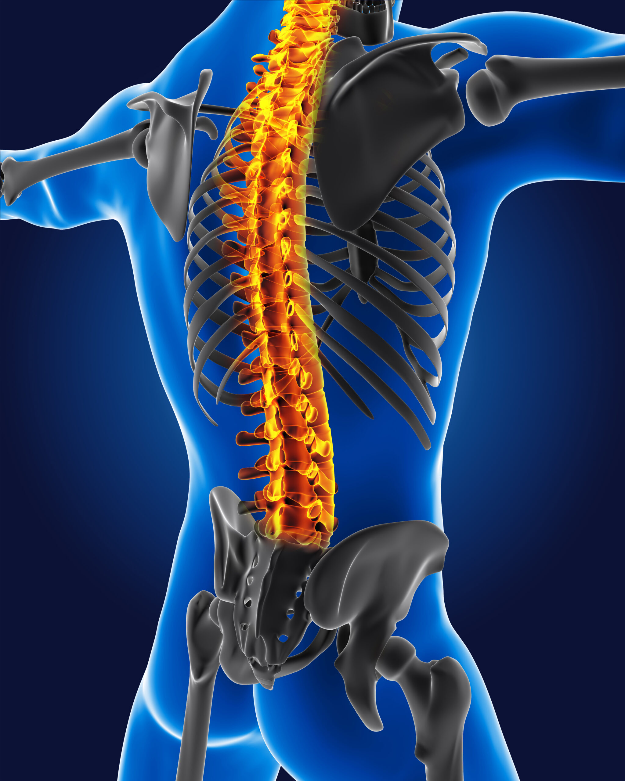 3D illustration of the human spine highlighting scoliosis