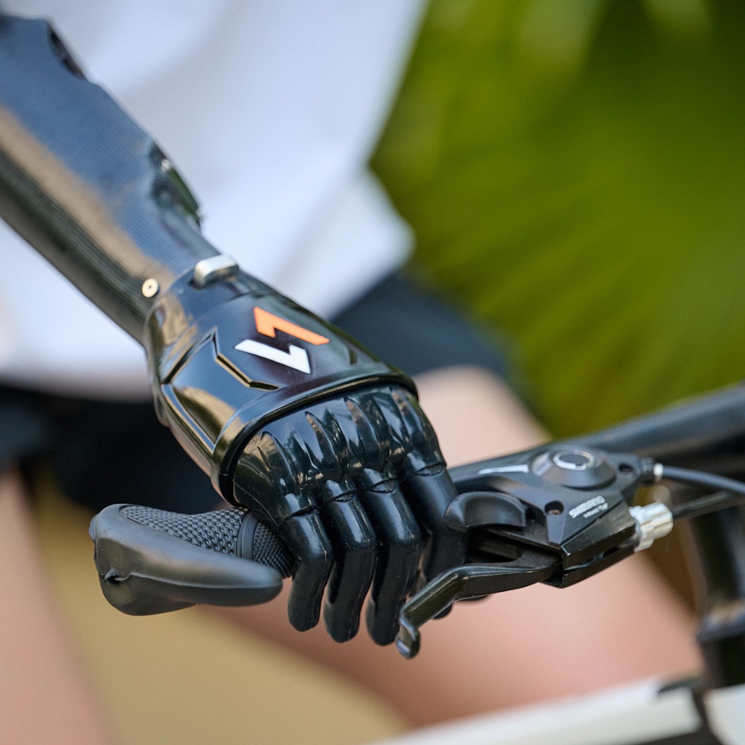 Upper limb prosthesis for hand and arm amputation